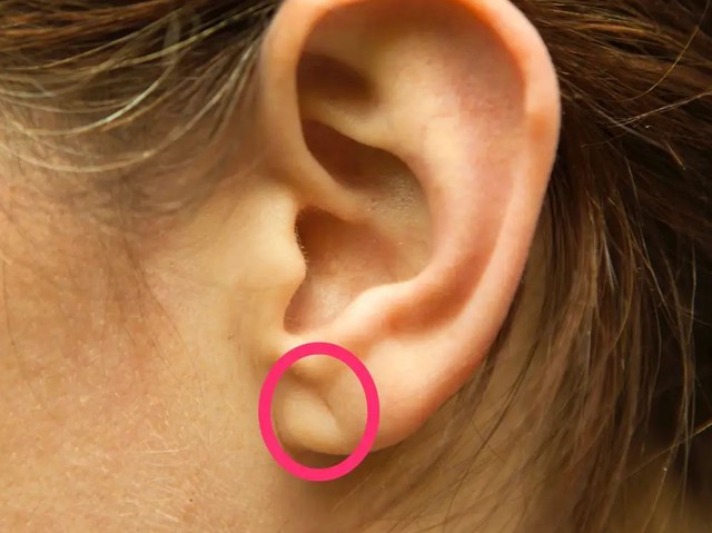Dấu hiệu Frank, một nếp nhăn chéo ở dái tai, có thể là dấu hiệu của bệnh tim. (Ảnh minh họa)